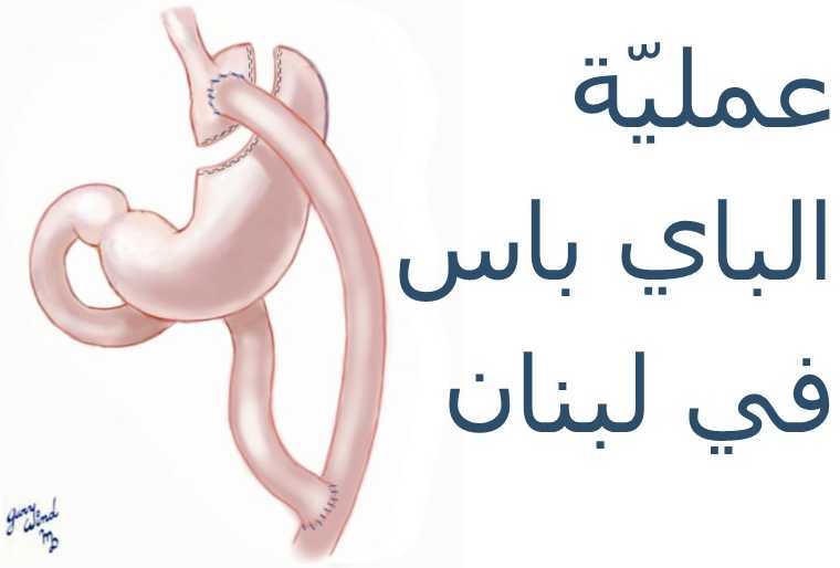 عملي ة الباي باس في لبنان عملية تحوير المعدة في لبنان مخاطر عملية تحوير المعدة في لبنان مخاطر عملي ة الباي باس في لبنان عوارض جراحة البدانة في لبنان