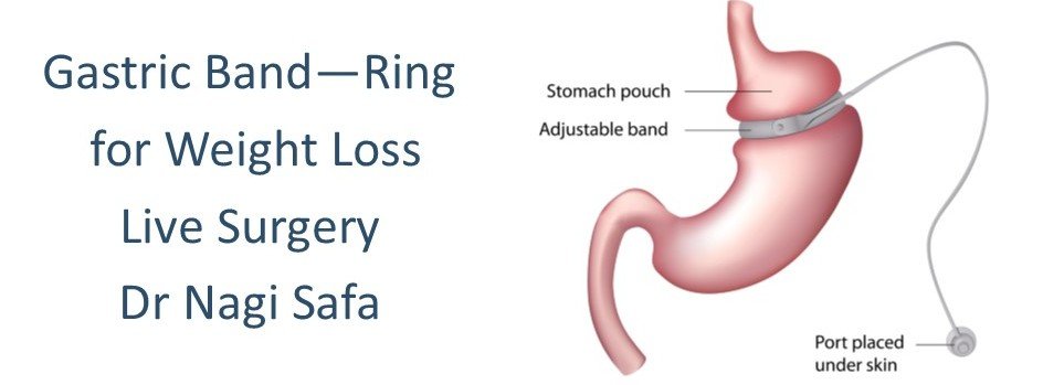 Live Gastric Band Surgery