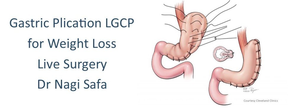 Gastric Plication LGCP Surgery Lebanon 2014