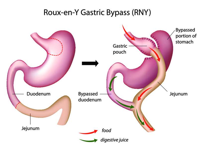 The Gastric Bypass Surgery in Beirut Lebanon