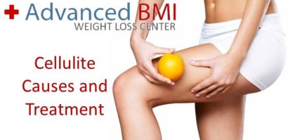 Cellulite Causes and Treatment