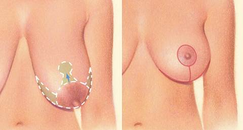تصغير الثدي أو تصغير الصدر في لبنان