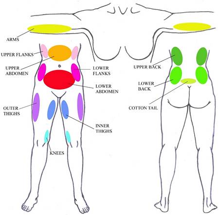 Liposuction areas in Lebanon Advanced BMI Liposuction areas in Lebanon Advanced BMI