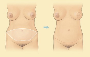 Tummy tuck or abdominoplasty in Lebanon