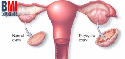 PCOS - Polycystic Ovarian Syndrome and weight gain - Advanced BMI Lebanon