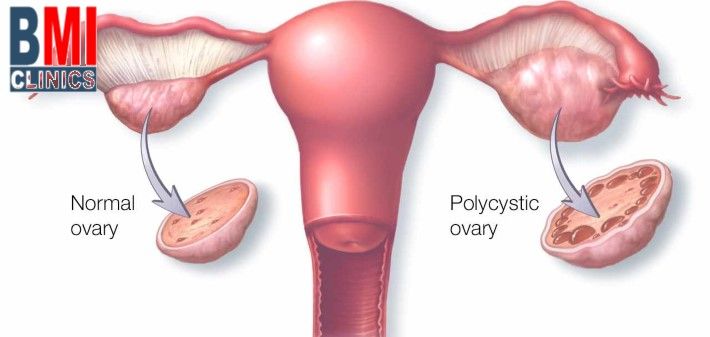PCOS - Polycystic Ovarian Syndrome and weight gain - Advanced BMI Lebanon