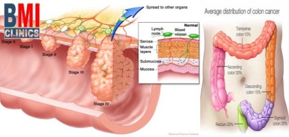 Reduce Your Risk of Colon Cancer - Advanced BMI Lebanon