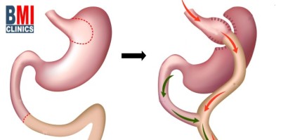 مضاعفات عملية تحوير المعدة