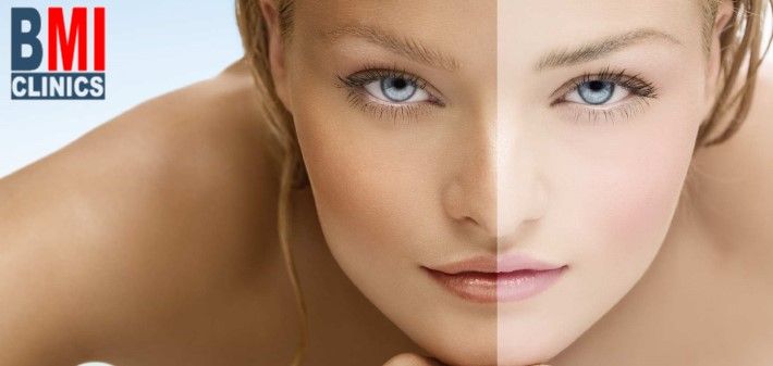 Hyperpigmentation - Top 5 Causes and Treatments - Lebanon