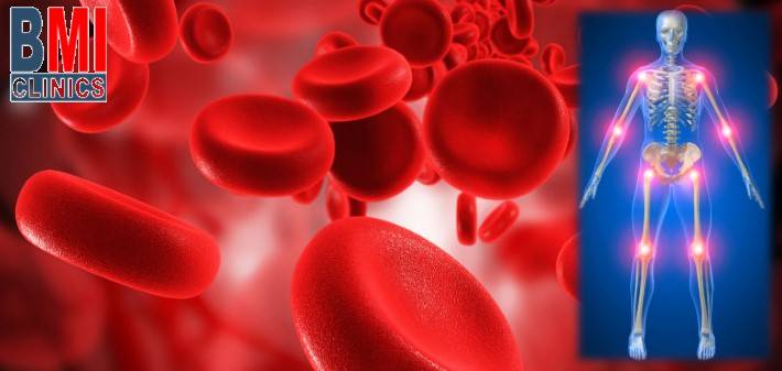 PRP therapy or Platelet Rich Plasma injection - Lebanon
