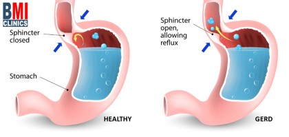 حموضة المعدة و إرتجاع المريء
