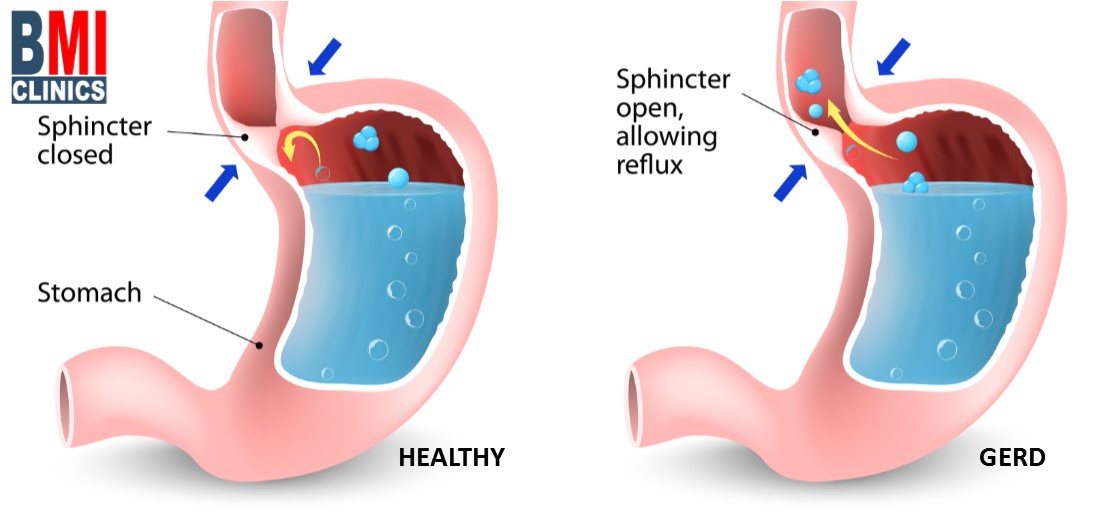 حموضة المعدة و إرتجاع المريء
