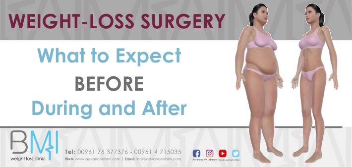 Weight-Loss Surgery What to Expect Before During and After