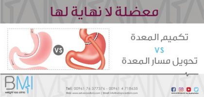 ما الفرق بين تكميم المعدة و تحويل مسار المعدة ؟