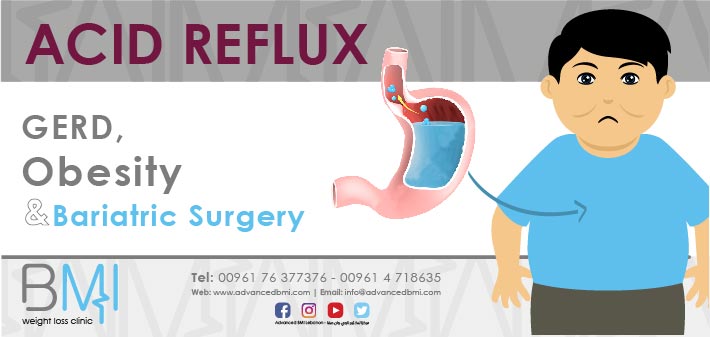 Acid Reflux, GERD, Obesity and Bariatric Surgery