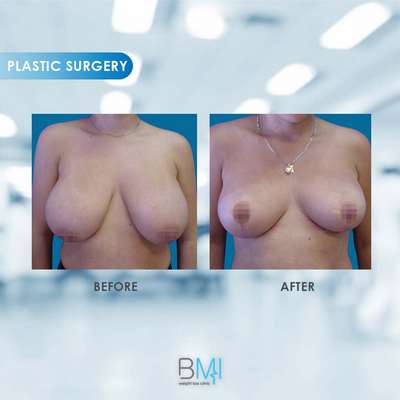 1 Breast Advanced BMI Beirut Lebanon Dr Nagi Safa