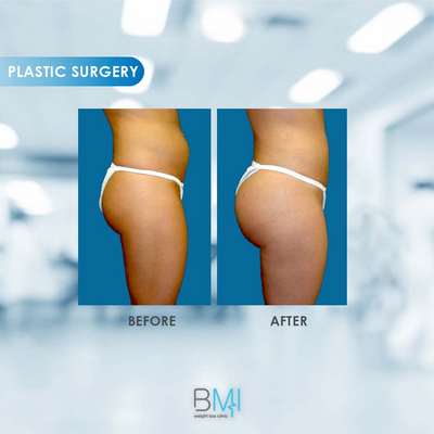 1 Buttock Advanced BMI Beirut Lebanon Dr Nagi Safa