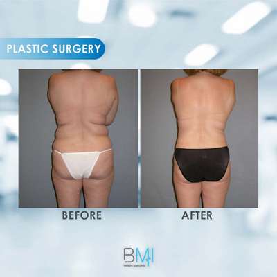 1 Liposuction Advanced BMI Beirut Lebanon Dr Nagi Safa