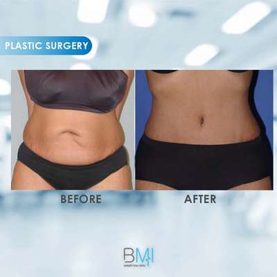 1 Tummy Tuck Advanced BMI Beirut Lebanon Dr Nagi Safa