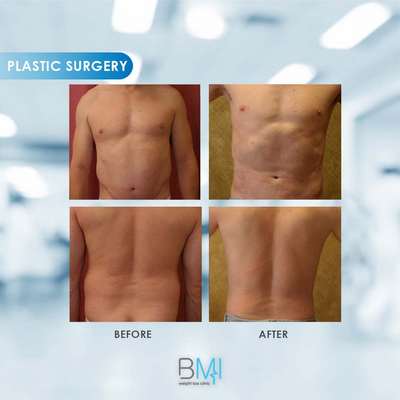 10 Liposuction Advanced BMI Beirut Lebanon Dr Nagi Safa