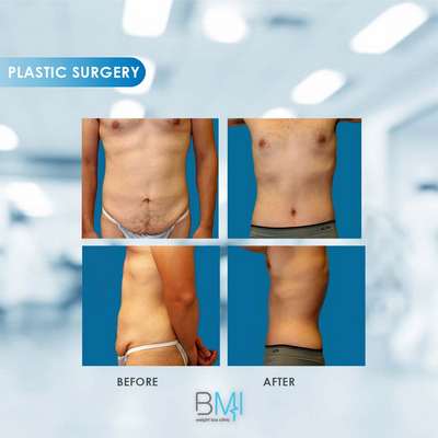 10 Tummy tuck Advanced BMI Beirut Lebanon Dr Nagi Safa