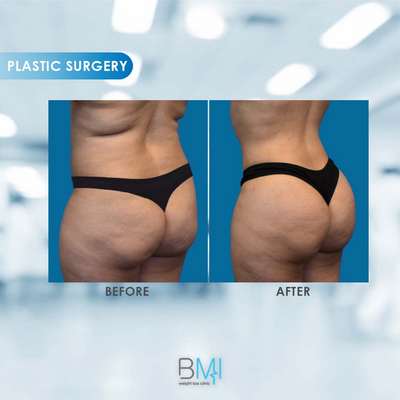 11 Buttock Advanced BMI Beirut Lebanon Dr Nagi Safa