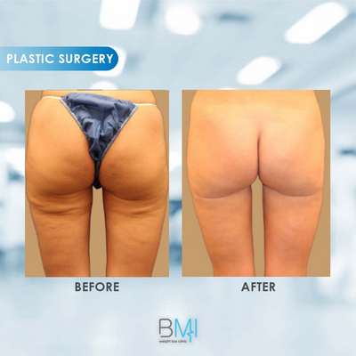 11 Thighs Liposuction Advanced BMI Beirut Lebanon Dr Nagi Safa