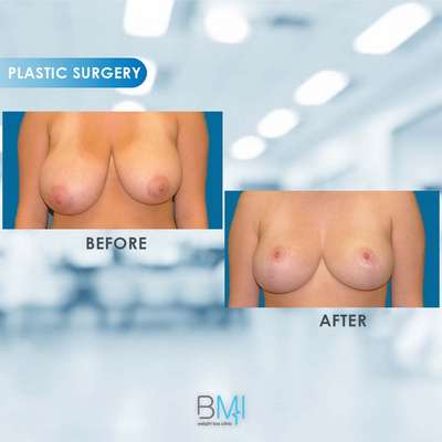 12 Breast Advanced BMI Beirut Lebanon Dr Nagi Safa