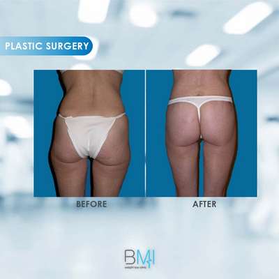 12 Buttock Advanced BMI Beirut Lebanon Dr Nagi Safa