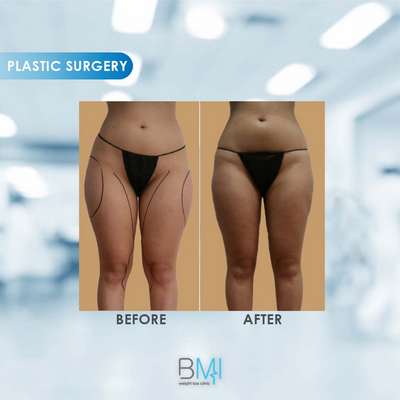 12 Thighs Liposuction Advanced BMI Beirut Lebanon Dr Nagi Safa