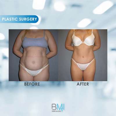 12 Tummy tuck Advanced BMI Beirut Lebanon Dr Nagi Safa