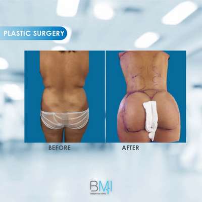 13 Buttock Advanced BMI Beirut Lebanon Dr Nagi Safa