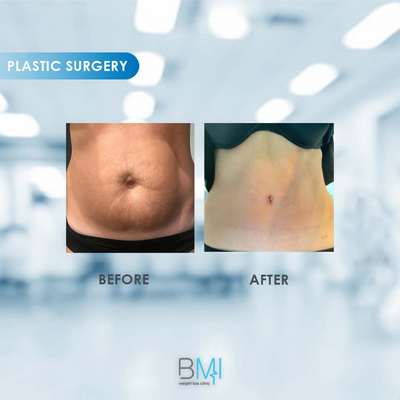 14 Tummy tuck Advanced BMI Beirut Lebanon Dr Nagi Safa