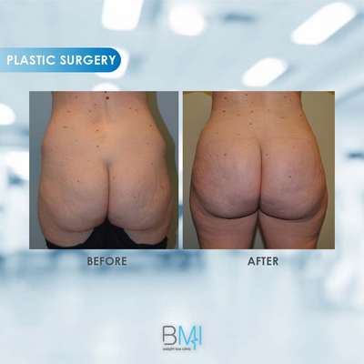 15 Buttock Advanced BMI Beirut Lebanon Dr Nagi Safa