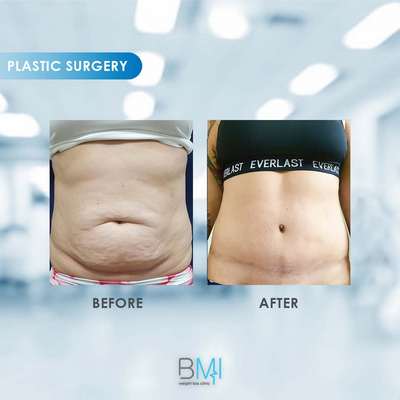 15 Tummy tuck Advanced BMI Beirut Lebanon Dr Nagi Safa