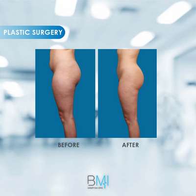 16 Buttock Advanced BMI Beirut Lebanon Dr Nagi Safa
