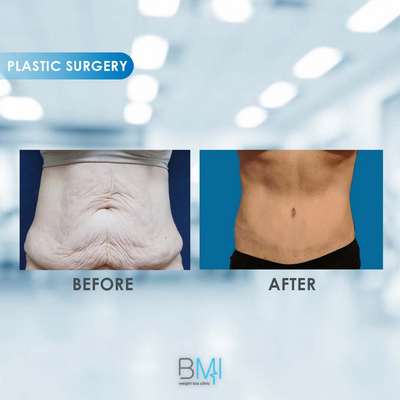 16 Tummy tuck Advanced BMI Beirut Lebanon Dr Nagi Safa