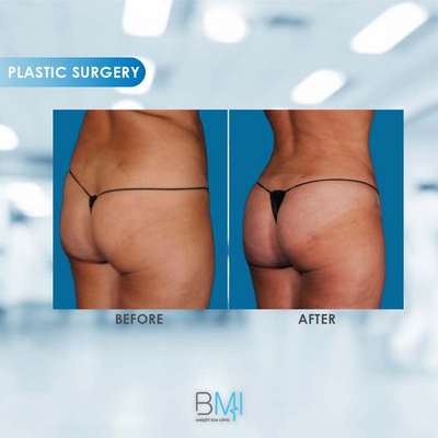 17 Buttock Advanced BMI Beirut Lebanon Dr Nagi Safa