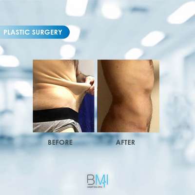 17 Tummy tuck Advanced BMI Beirut Lebanon Dr Nagi Safa