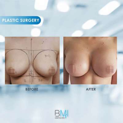 18 Breast Advanced BMI Beirut Lebanon Dr Nagi Safa