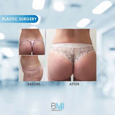 18 Buttock Advanced BMI Beirut Lebanon Dr Nagi Safa