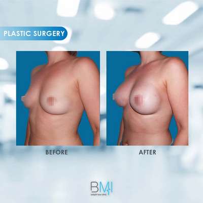 2 Breast Advanced BMI Beirut Lebanon Dr Nagi Safa