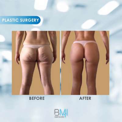 2 Buttock Advanced BMI Beirut Lebanon Dr Nagi Safa