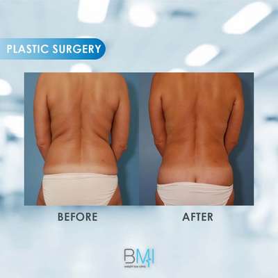 2 Liposuction Advanced BMI Beirut Lebanon Dr Nagi Safa