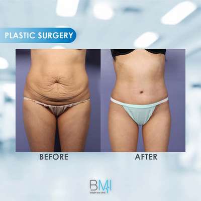 2 Tummy tuck Advanced BMI Beirut Lebanon Dr Nagi Safa