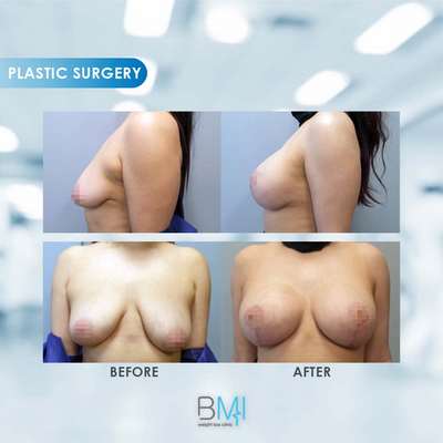 3 Breast Advanced BMI Beirut Lebanon Dr Nagi Safa