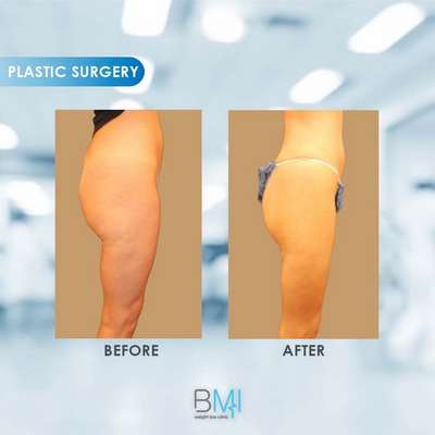 3 Buttock Advanced BMI Beirut Lebanon Dr Nagi Safa