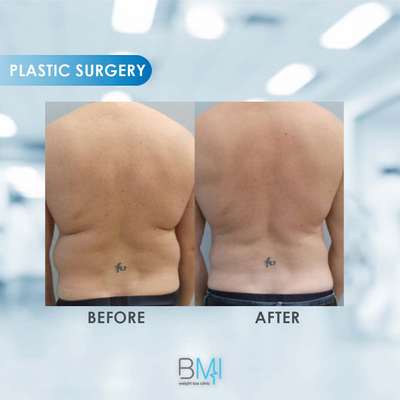 3 Liposuction Advanced BMI Beirut Lebanon Dr Nagi Safa