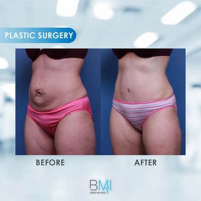 3 Tummy tuck Advanced BMI Beirut Lebanon Dr Nagi Safa