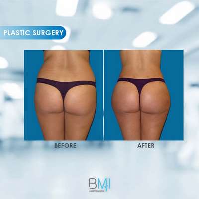 4 Buttock Advanced BMI Beirut Lebanon Dr Nagi Safa